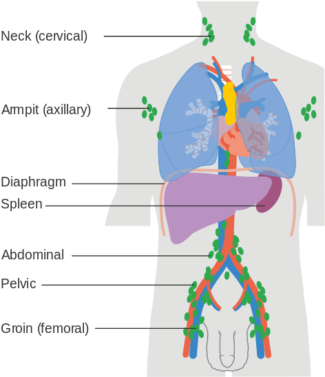 Download Non Hodgkin's Lymphoma - ClipartKey