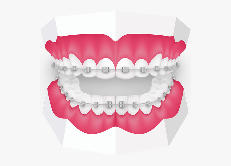 Fixed Braces At Toothbeary - Orthodontics Png, free clipart download, png, clipart...