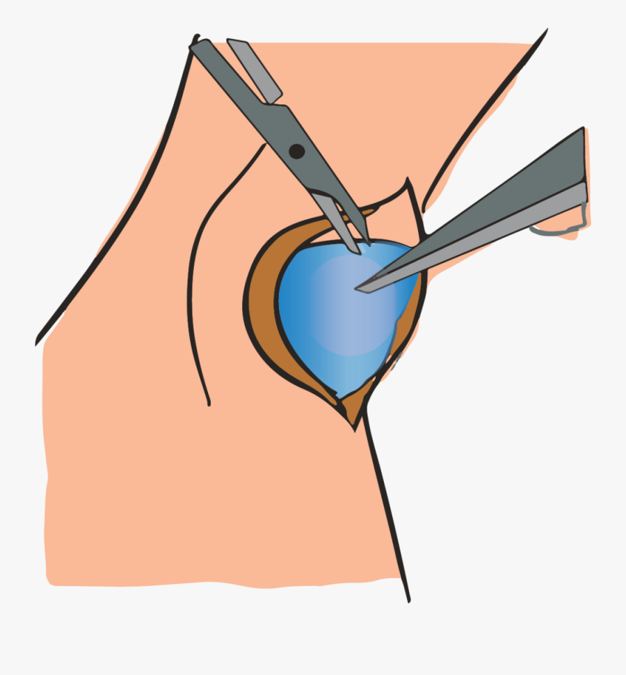 Removing Ganglion Cyst Through Surgery, Transparent Clipart