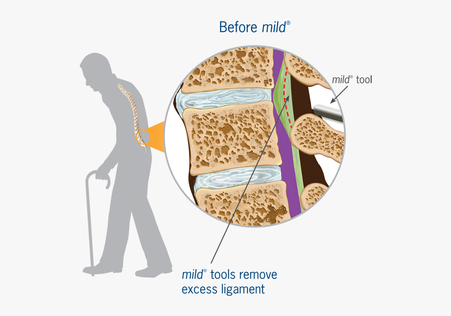 Before Mild - Spinal Stenosis Mild Procedure, Transparent Clipart