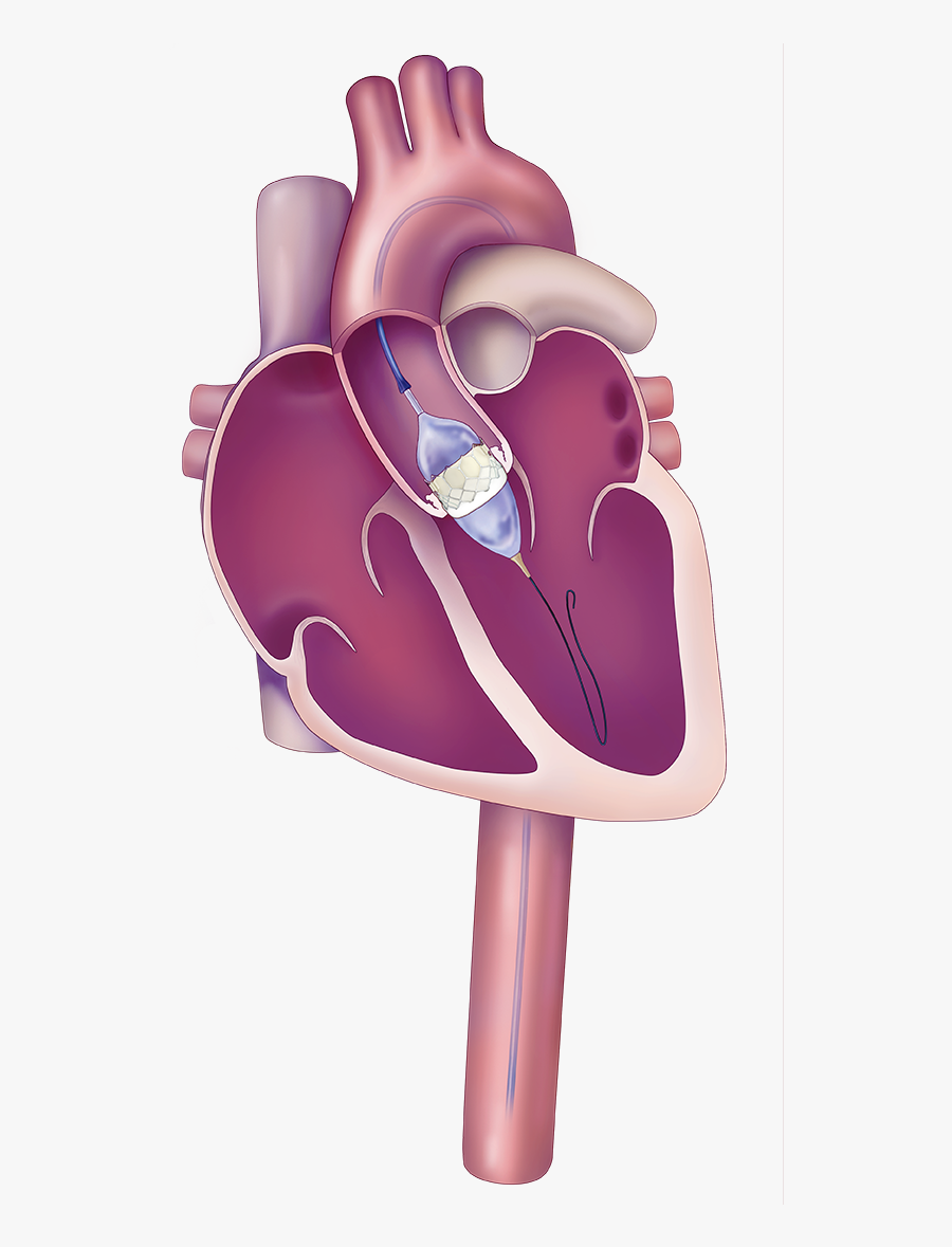 Visualization Of Prosthetic Valve Being Implanted Via - Tavr Valve, Transparent Clipart