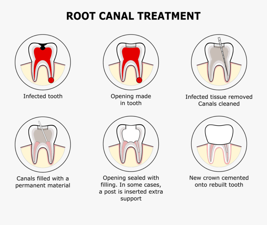 Root Canal Filling Replacement, Transparent Clipart