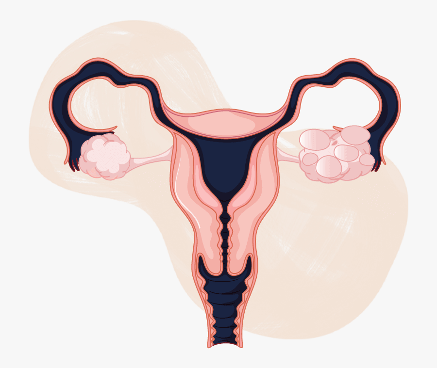 Pcos And Pregnancy - Ovarian Cancer Drawing, Transparent Clipart