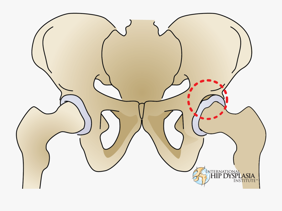 Where Torn Labrums Happen - Resonancia Magnetica Rotura De Labrum, Transparent Clipart