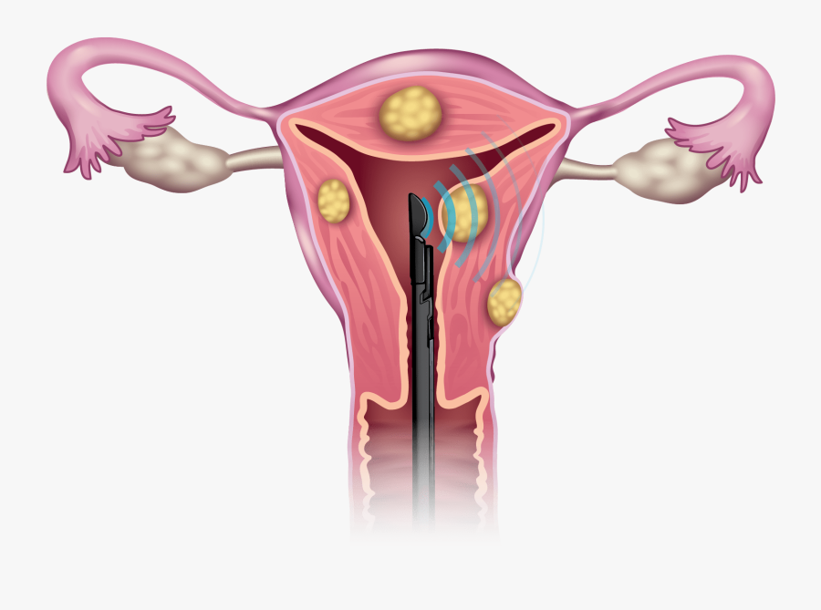 Fibroid Transparent, Transparent Clipart