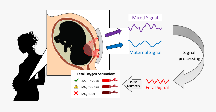 Fetal Oximetry, Transparent Clipart
