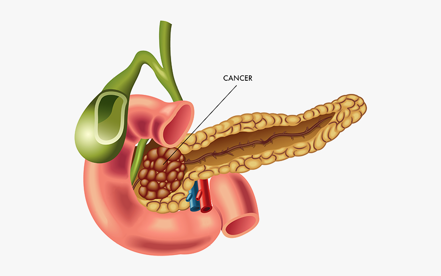 Pancreatic Cancer - Pancreatic Cancer In Chinese, Transparent Clipart