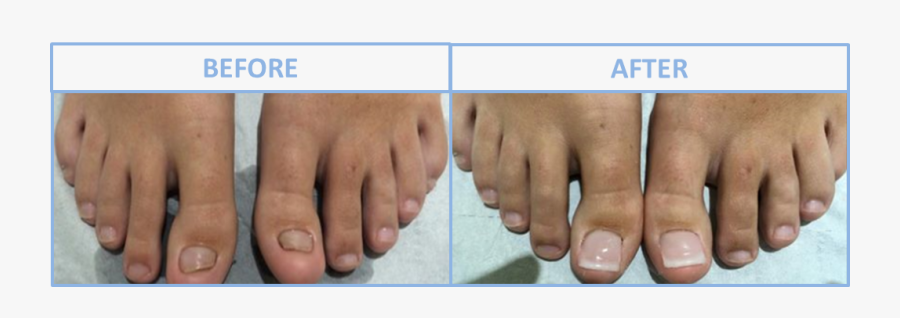 Transparent Fingernail Png - Toe Nail Reconstruction Surgery, Transparent Clipart