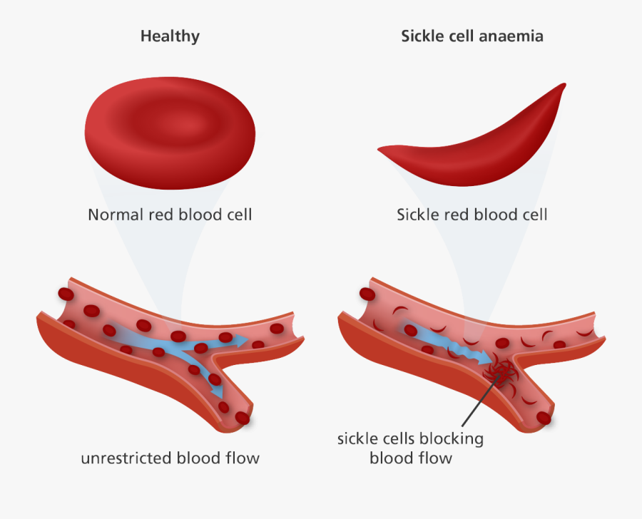 John Brown Diagnosed With Sickle Cell Trait - Red Blood Cell Sickle Cell, Transparent Clipart