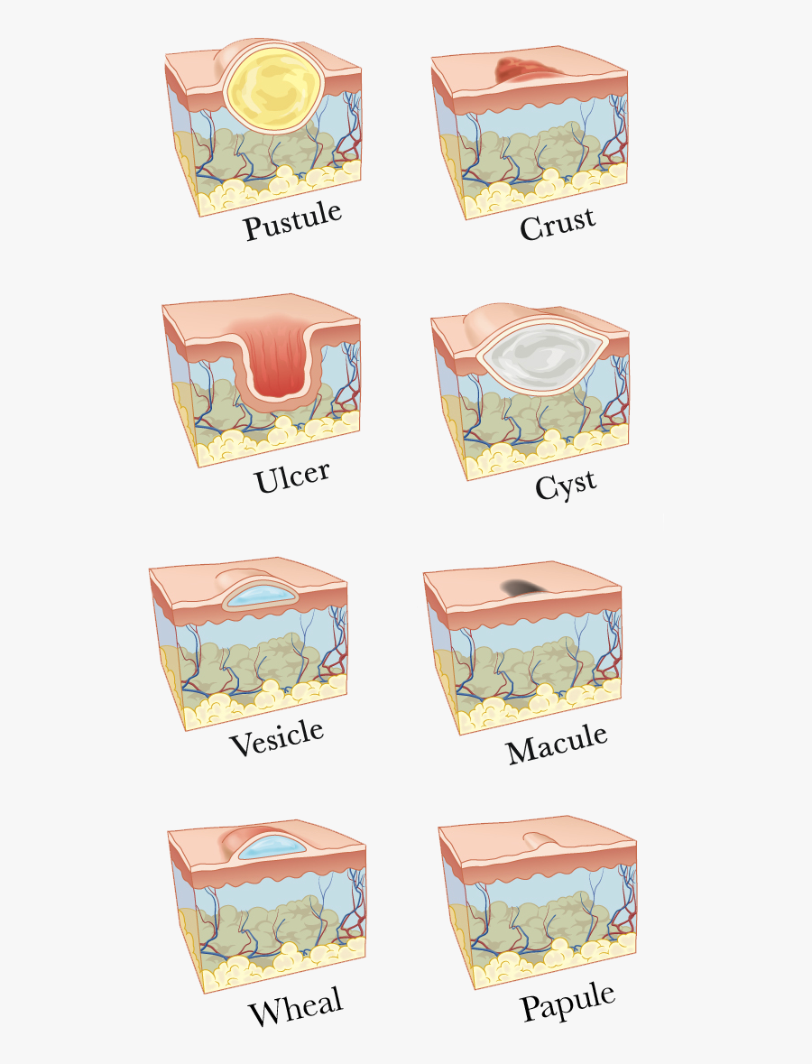 Types Of Skin Lesions, Transparent Clipart