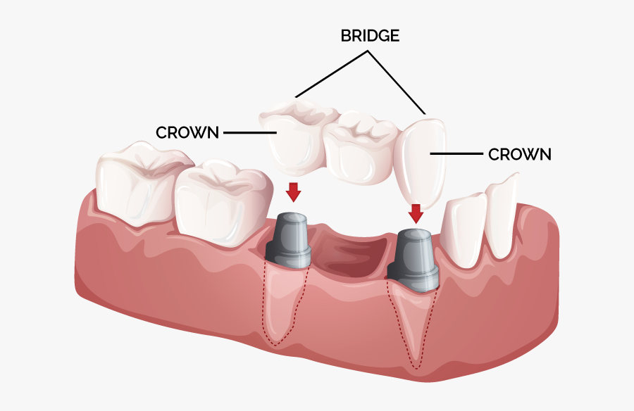 Tooth Bridge And Crown, Transparent Clipart