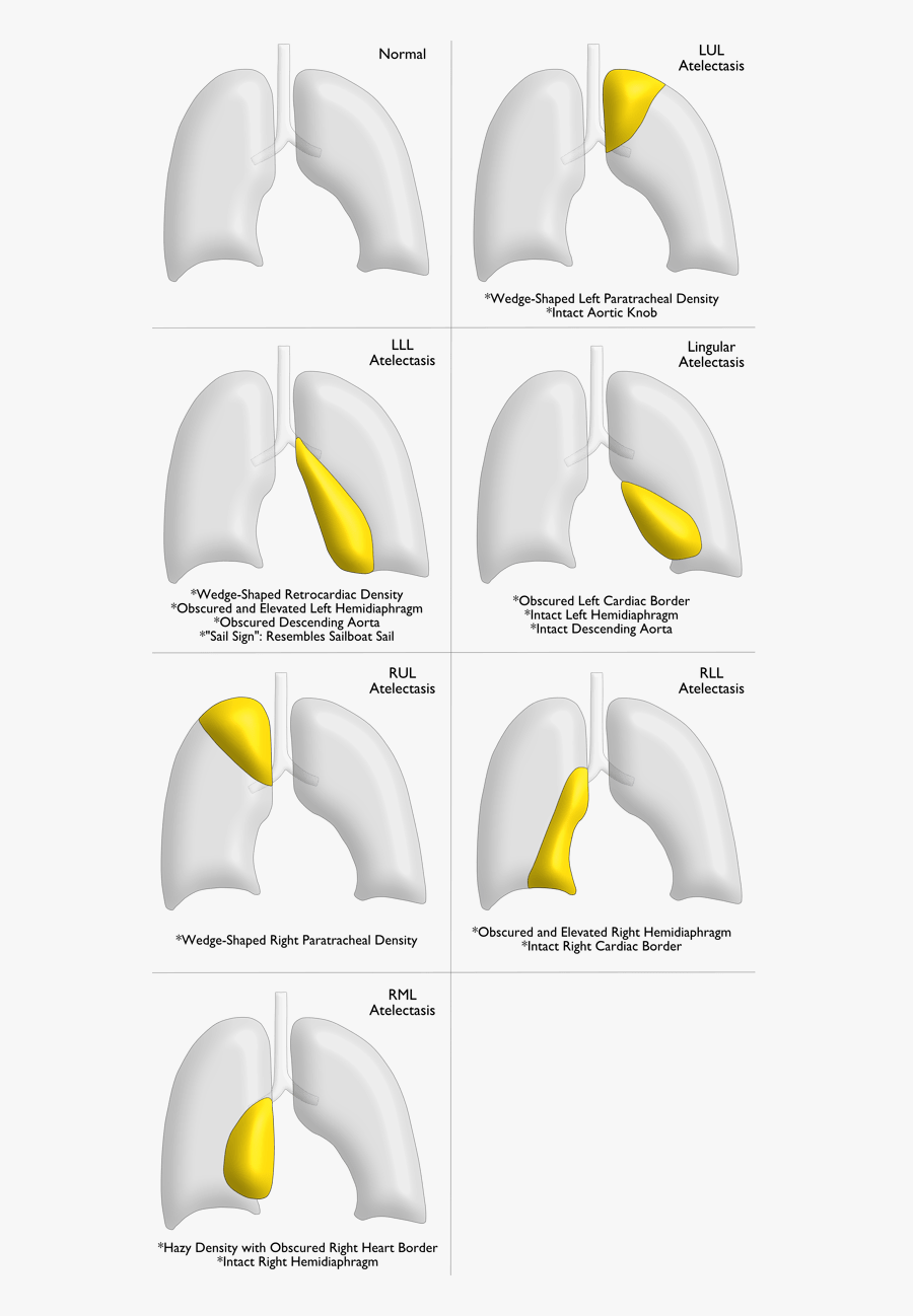 Cough Clipart Ambulation - Atelectasis Shift, Transparent Clipart