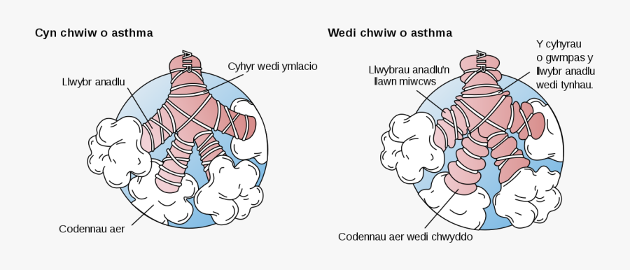 Asthma Before And After, Transparent Clipart