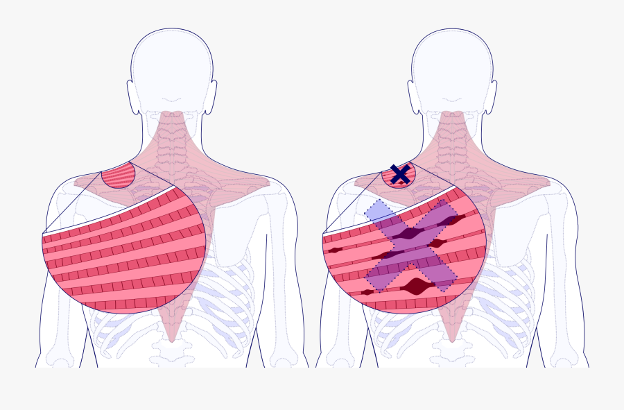 Transparent Muscles Tense Png - Muscle Nodules, Transparent Clipart