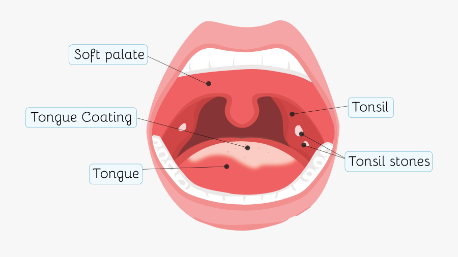 Clip Art Tonsillitis And Tonsil Stones - Immune System Tonsils, Transparent Clipart