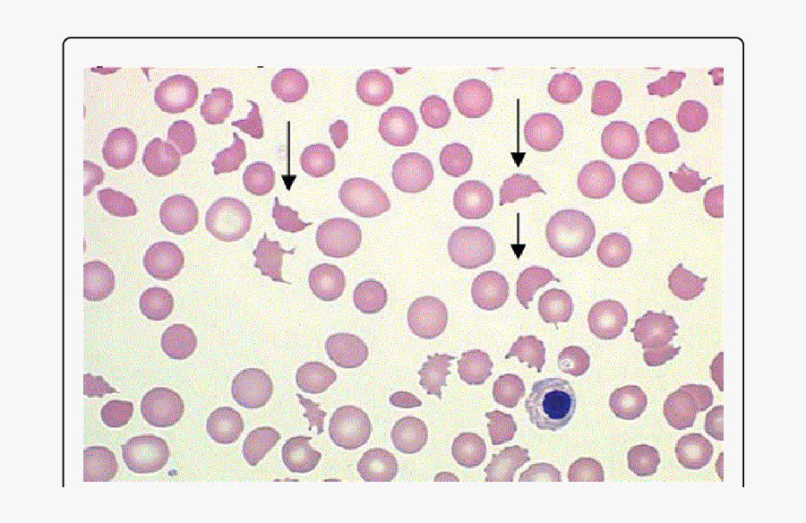 Clip Art Peripheral Blood Smear Of - Hemochromatosis Peripheral Blood Smear, Transparent Clipart