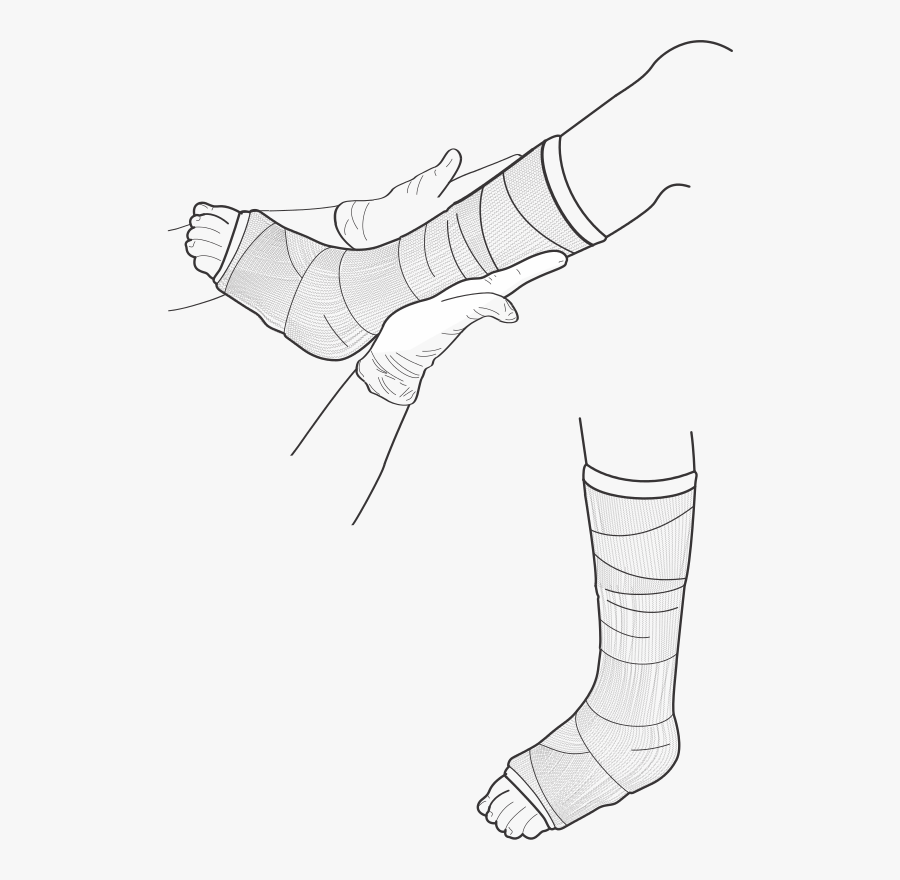 Leg Cast - Drawings Of Leg Casts, Transparent Clipart