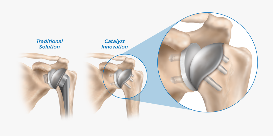 Clip Art Why Catalyst Orthoscience Research - Shoulder Implants, Transparent Clipart