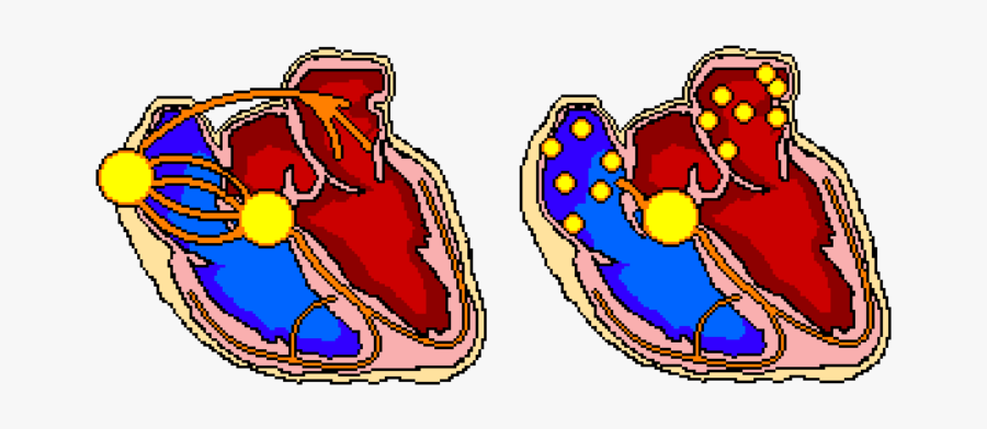 Af With Bundle Branch Block Animation, Transparent Clipart