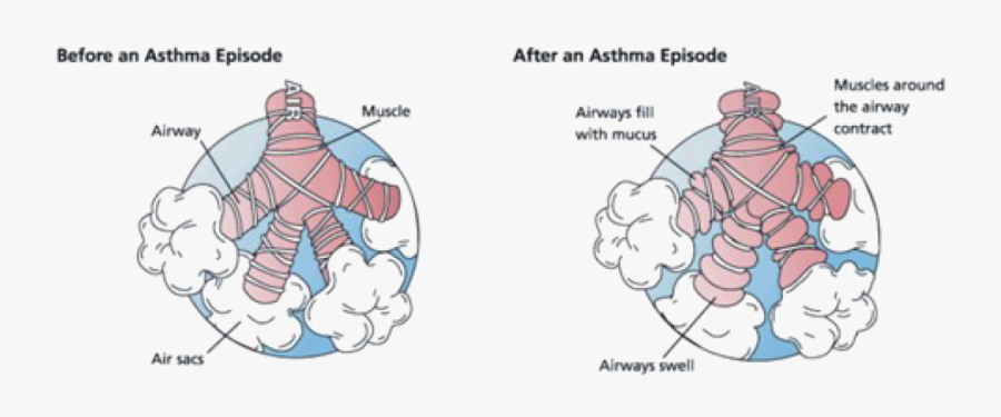 Bronchial Asthma , Free Transparent Clipart - Clipartkey