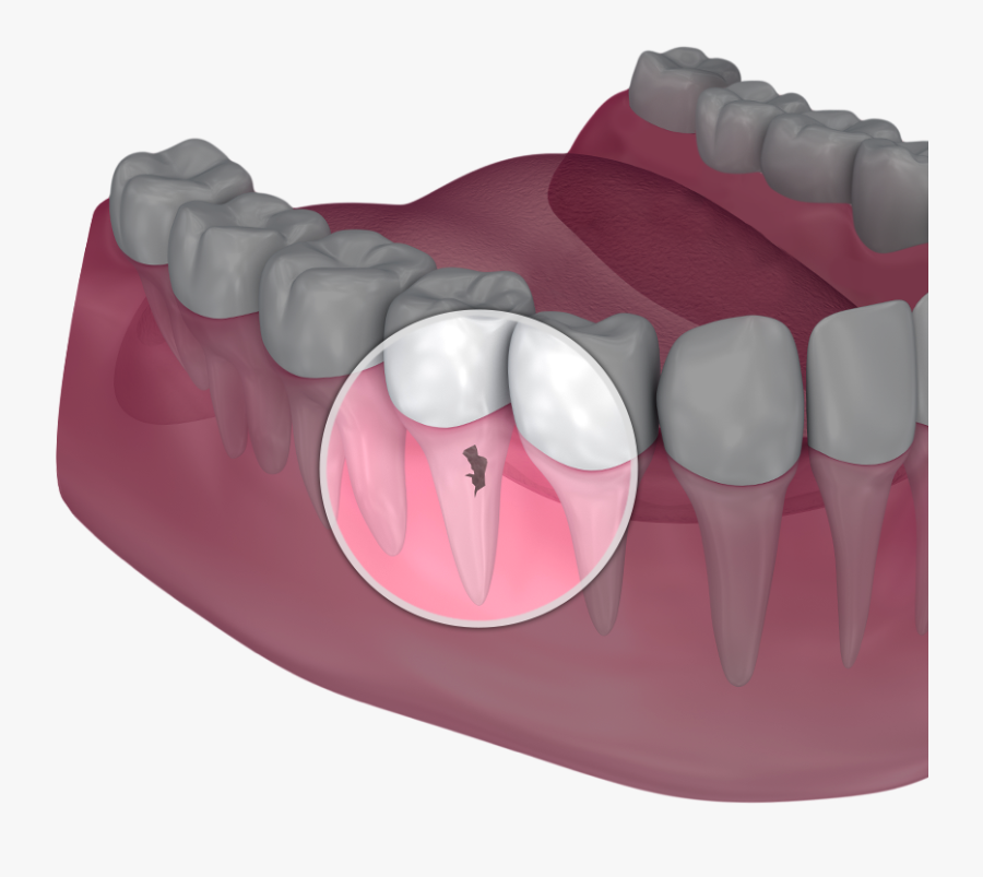 Crown Lengthening, Transparent Clipart