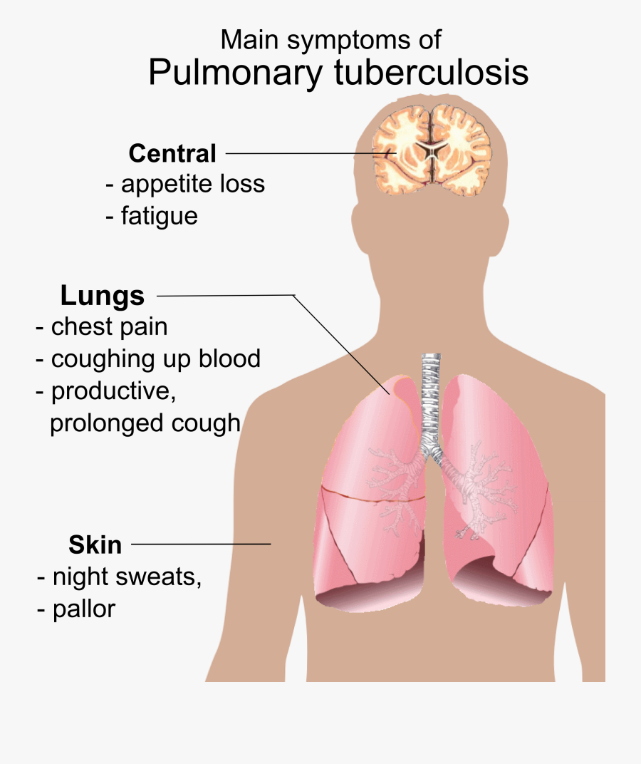 Lungs Clipart Tb Patient - Main Symptoms Of Pulmonary Tuberculosis, Transparent Clipart