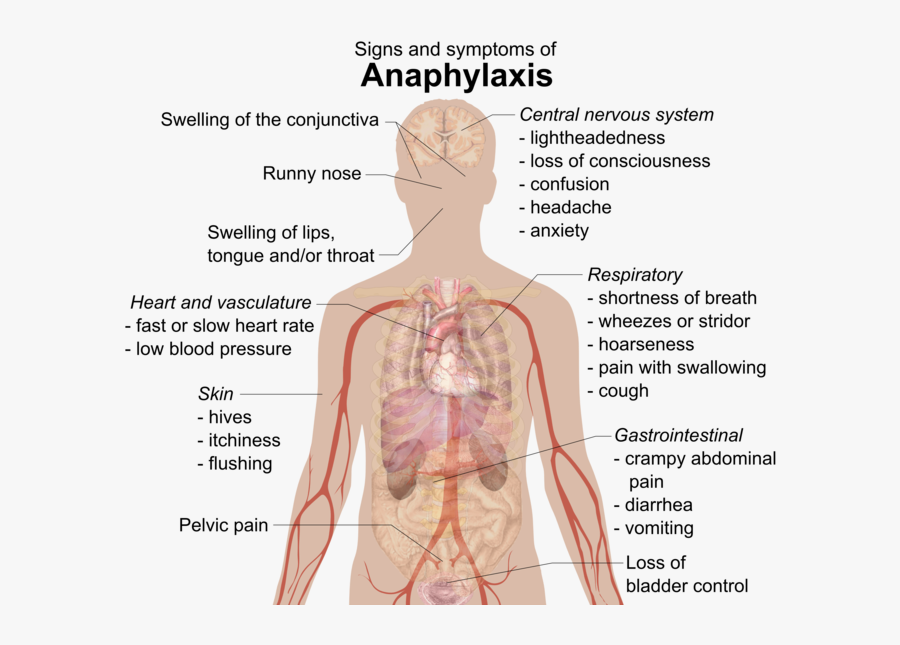 Image - Signs And Symptoms Of Anaphylaxis, Transparent Clipart