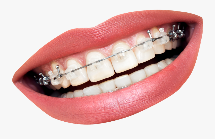 Mouth With Braces Transparent , Free Transparent Clipart - ClipartKey.