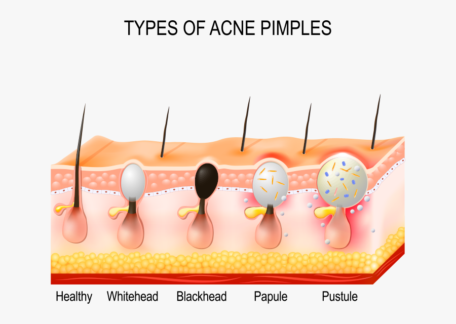 Acne Cancer Symptom, Transparent Clipart