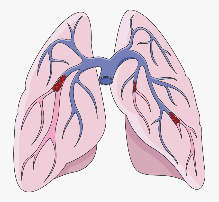 Pulmonary Embolism Clipart, Transparent Clipart