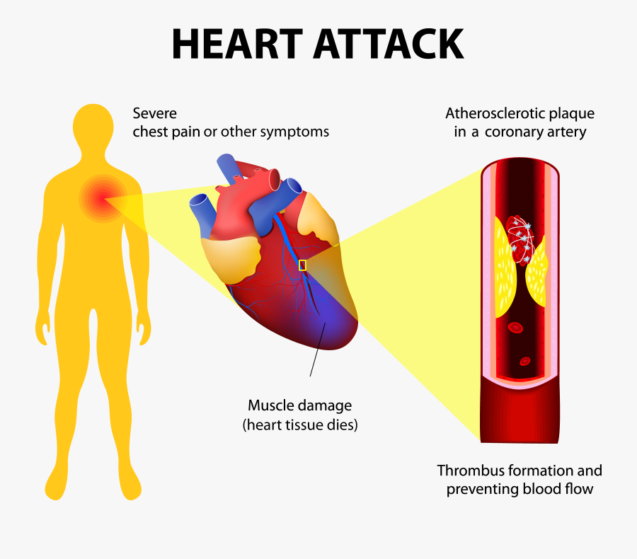 Heart-attack2 Adobestock - Heart Chest Pain, Transparent Clipart