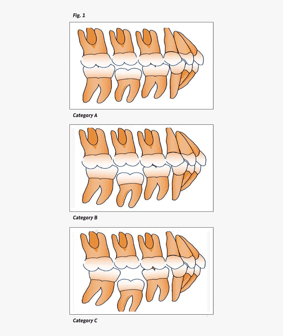Fig - - Infraoccluded Primary Molars Management, Transparent Clipart