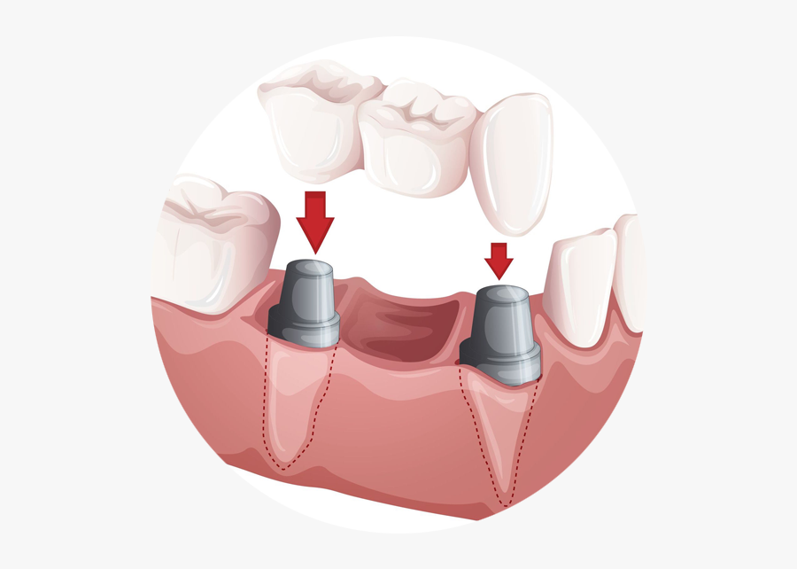 Dental Bridge, Transparent Clipart