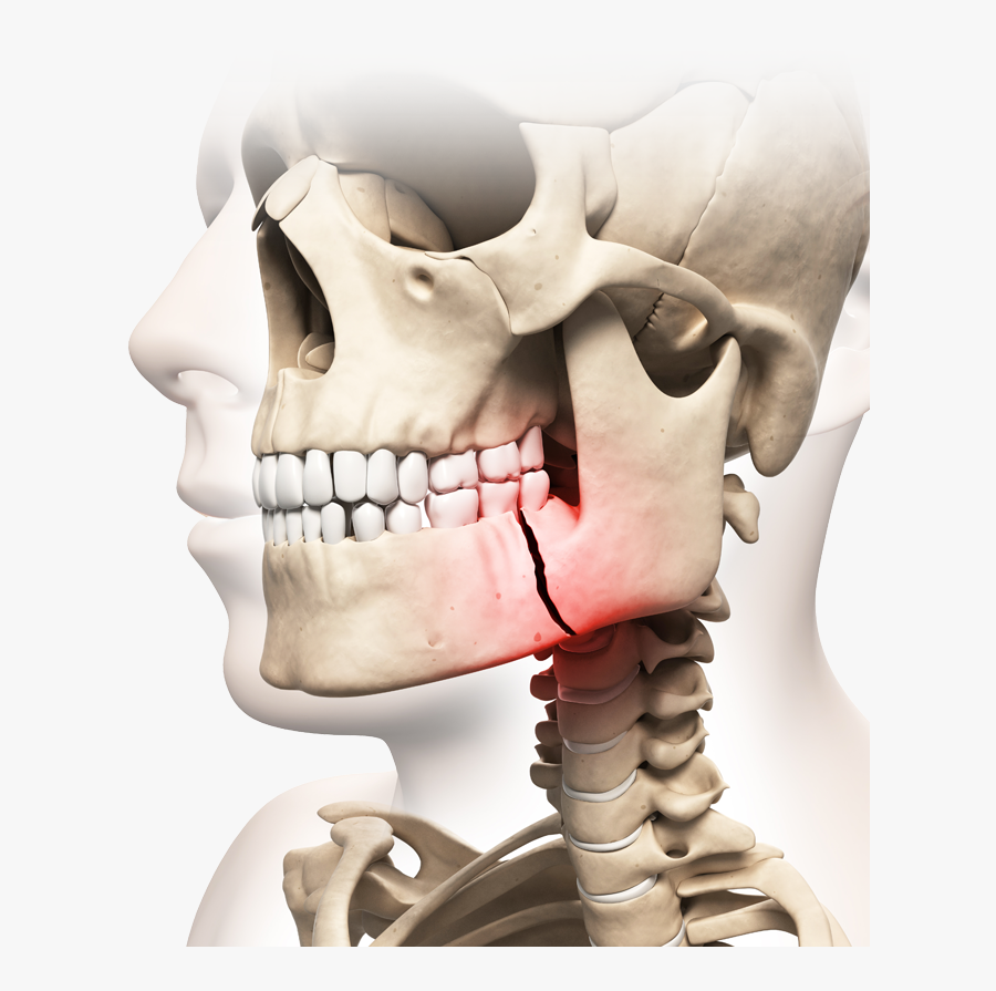 Illustration Of Skull With Broken Jaw Highlighted In - Jaw Fracture, Transparent Clipart