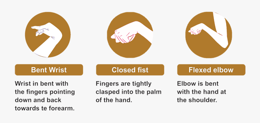 Physical Symptoms Of Cerebral Palsy - Cerebral Palsy Baby Hands, Transparent Clipart