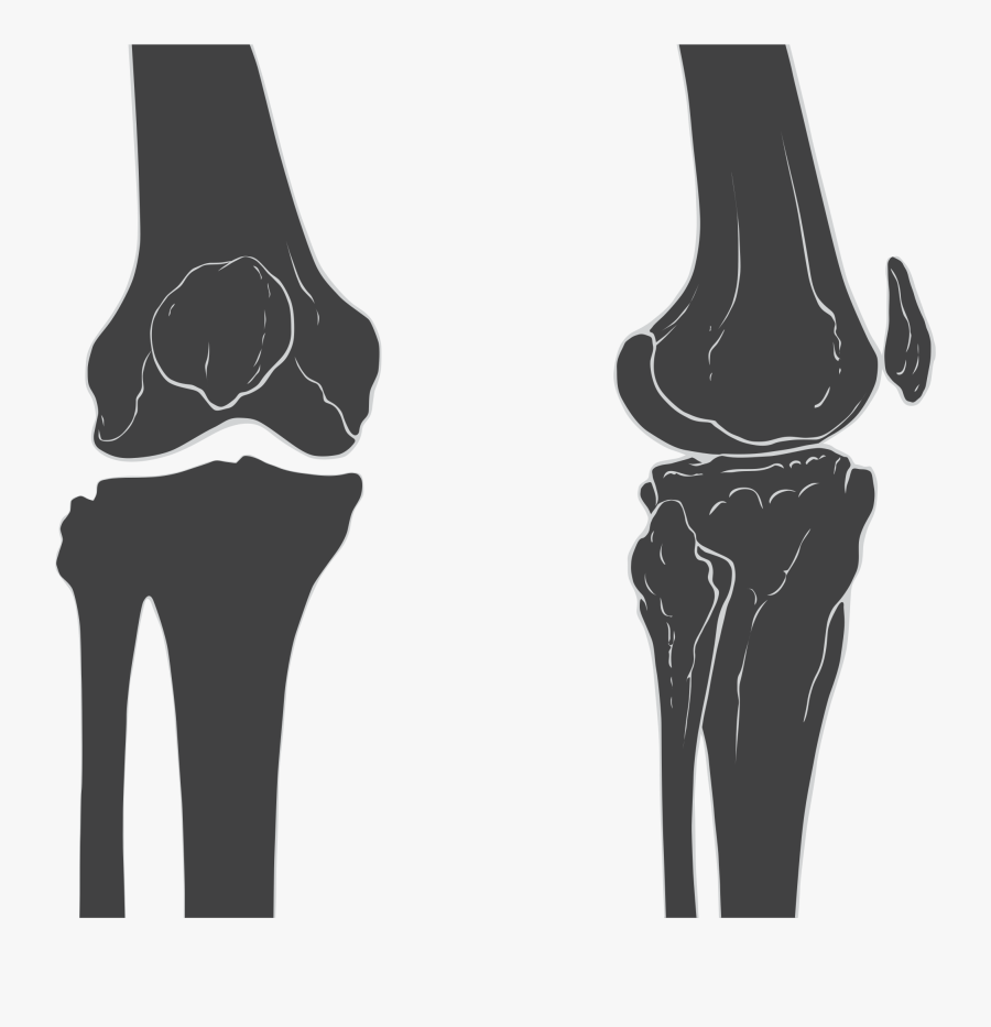 Knee Cap Skeleton , Free Transparent 