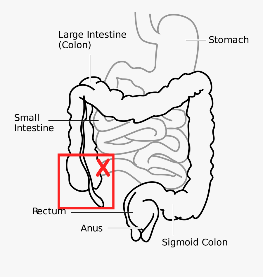 Diagram Showing The Portion Of Bowels Removed During - Human Organ System Drawing, Transparent Clipart