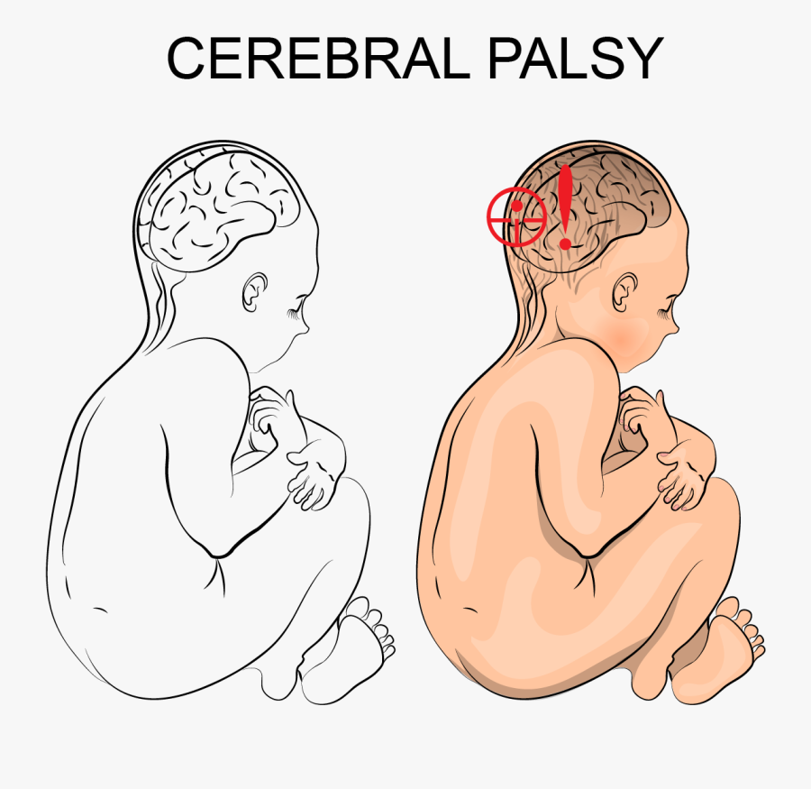 How Can I Tell If My Child Has Cerebral Palsy - Cerebral Palsy Brain Damage, Transparent Clipart