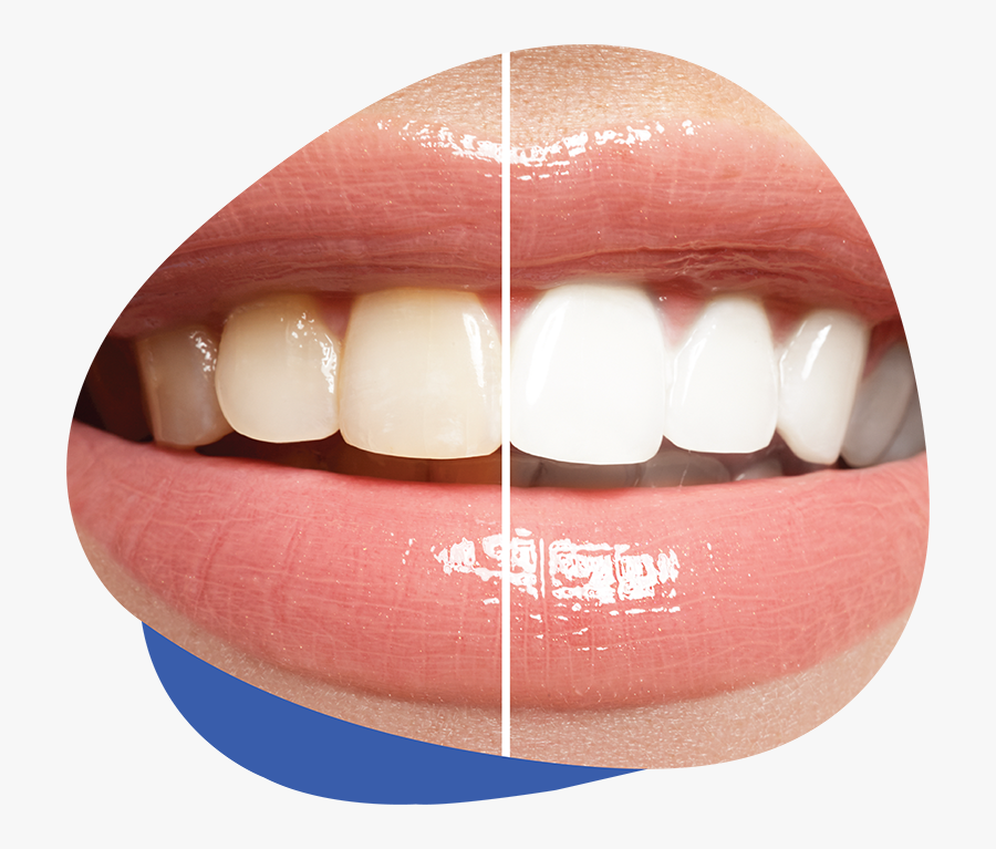 Teeth Whitening - Teeth Whitening Kit, Transparent Clipart
