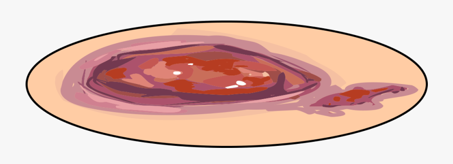 Illustration Of An Open Wound - Fast Food, Transparent Clipart