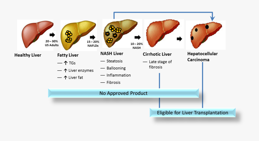 Liver Clipart Cirrhosis - Fatty Liver Progression , Free Transparent ...