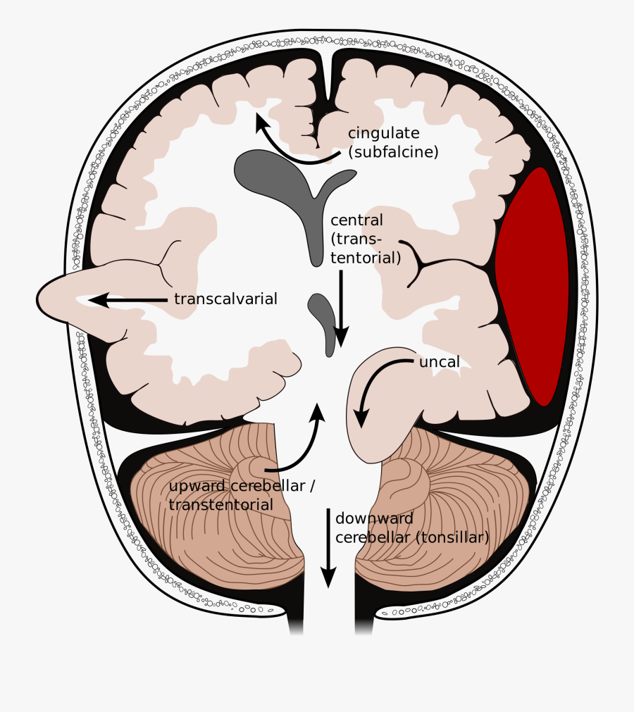 Head Injuries - Uncal Herniation, Transparent Clipart