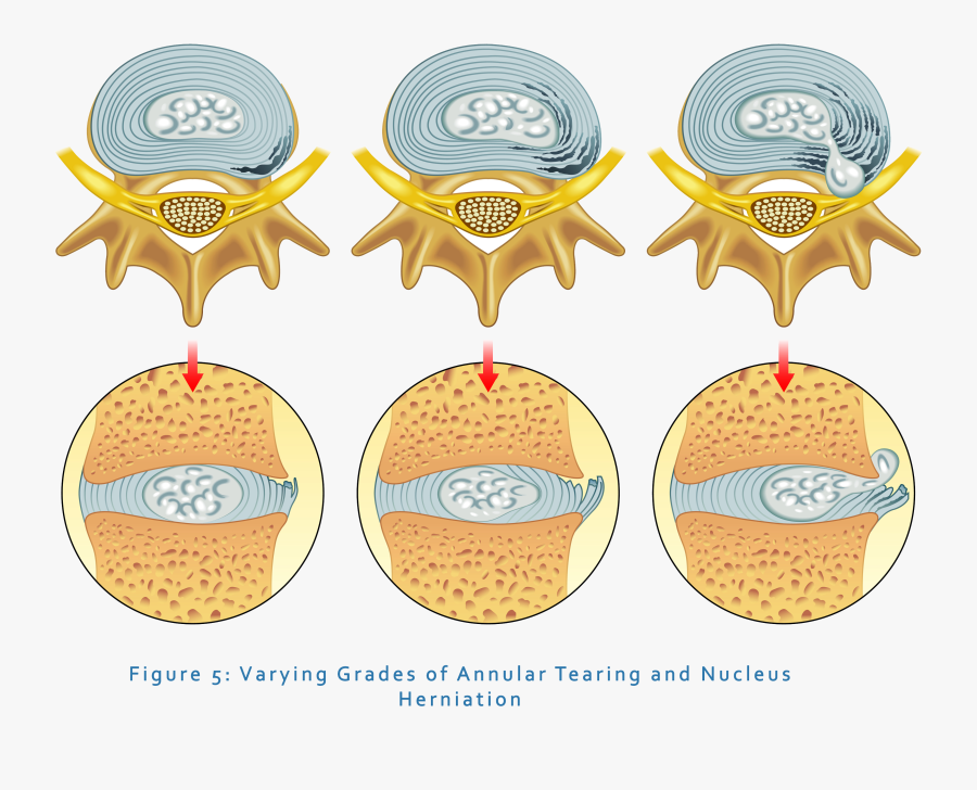 Degree Of Disc Bulge , Free Transparent Clipart - ClipartKey