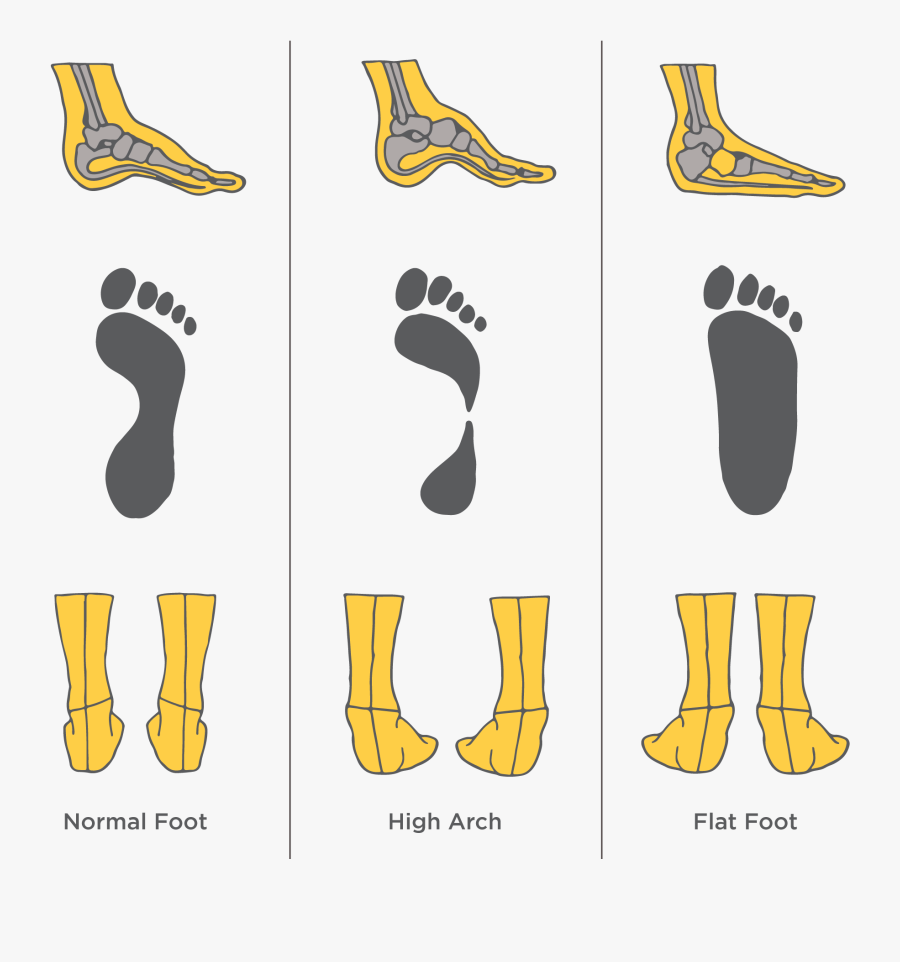 Ogden Clinic Foot Diagram - Opposite Of Flat Foot, Transparent Clipart