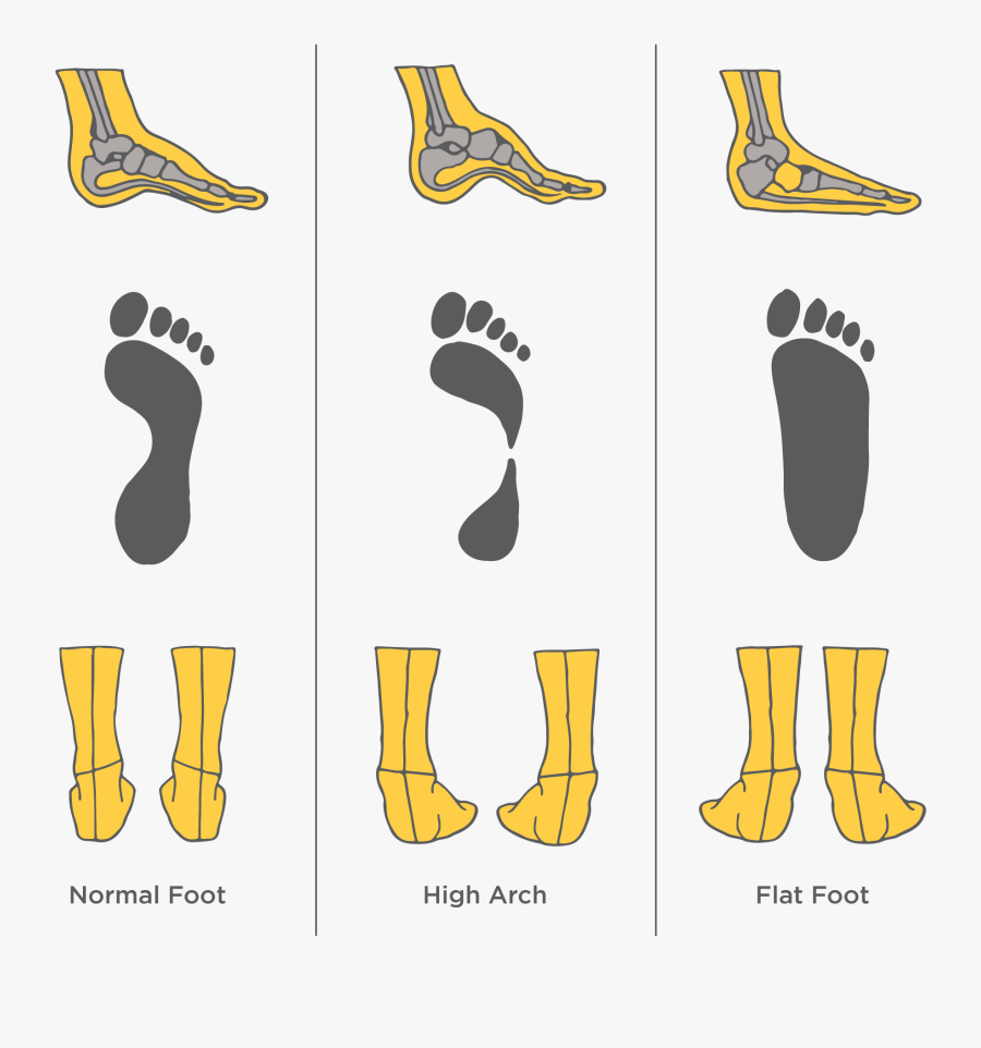 Ogden Clinic Foot Diagram Opposite Of Flat Foot Free Transparent 