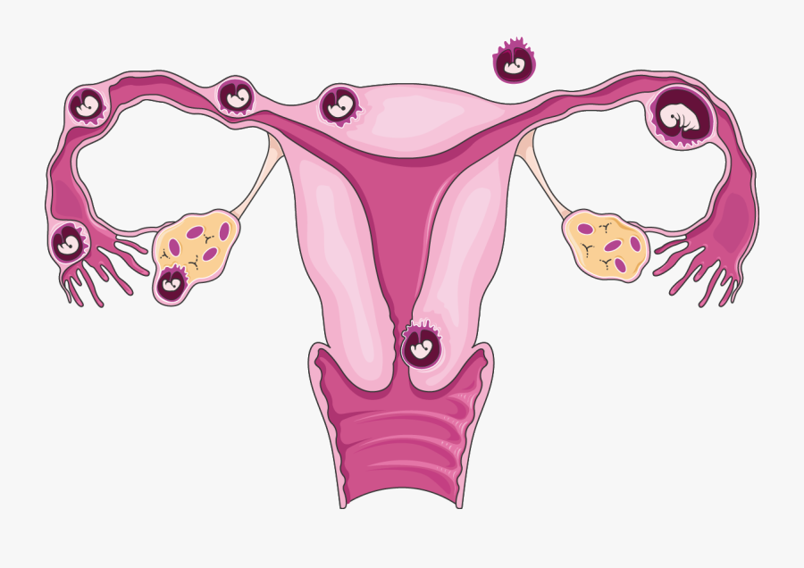 Download The Image - Ectopic Pregnancy Locations, Transparent Clipart