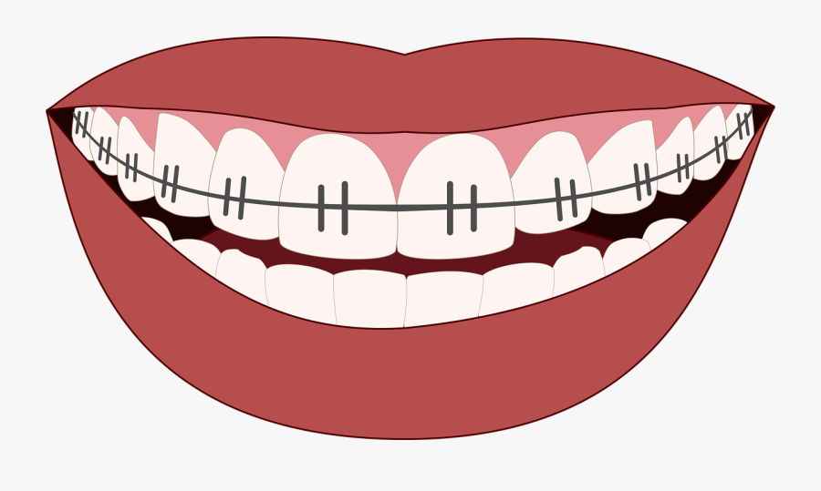 Dentist Images - Mouth With Braces Png, Transparent Clipart