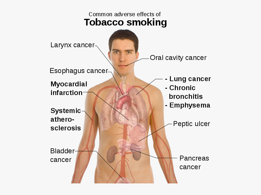 Transparent Human Body Clipart - Diseases In Circulatory System Caused By Smoking, Transparent Clipart