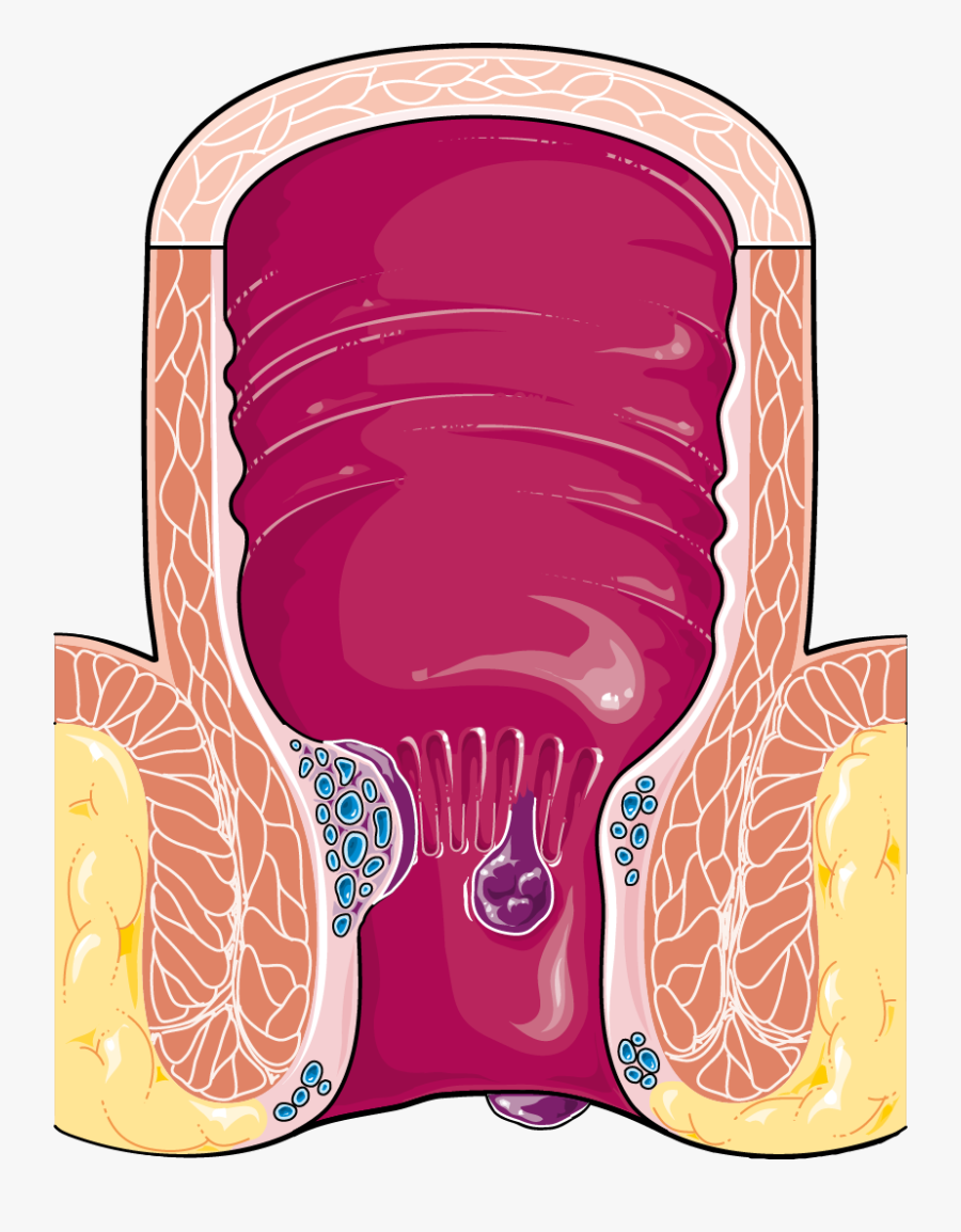 Hémorrhoides - Hemorrhoids Transparent, Transparent Clipart