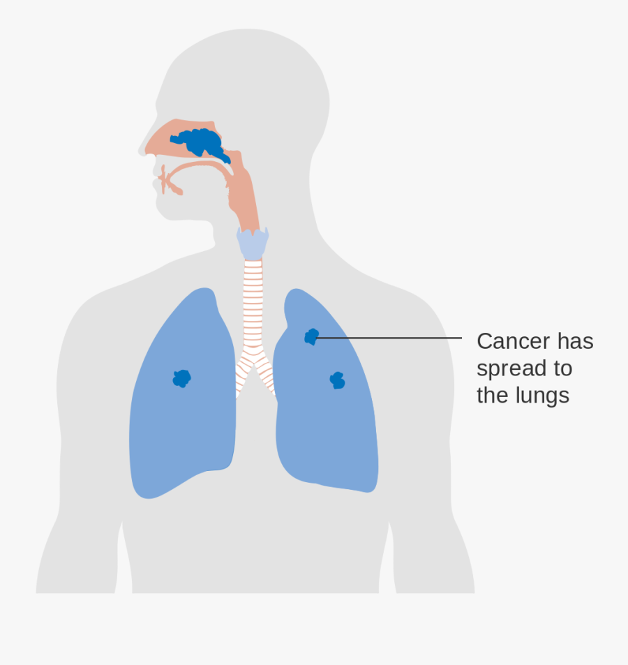 Nasal Cavity Cancer, Transparent Clipart